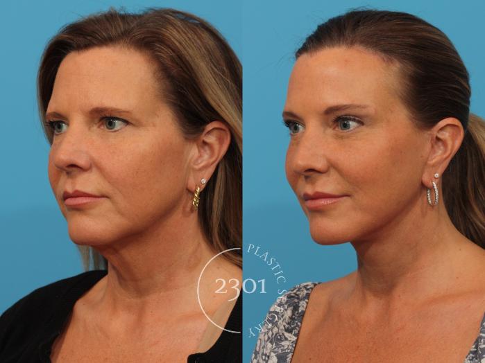 Before & After Face Lift Case 878 Left Oblique View in Fort Worth, Plano, & Frisco, Texas