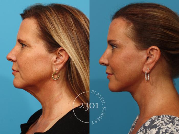 Before & After Face Lift Case 878 Left Side View in Fort Worth, Plano, & Frisco, Texas