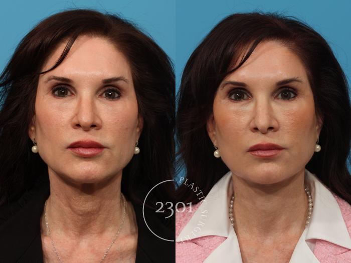 Before & After Face Lift Case 880 Front View in Fort Worth, Plano, & Frisco, Texas