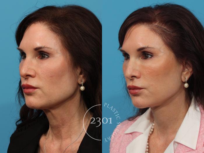 Before & After Face Lift Case 880 Left Oblique View in Fort Worth, Plano, & Frisco, Texas