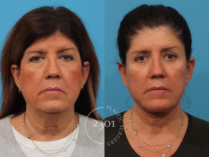 Before & After Face Lift Case 887 Front View in Fort Worth, Plano, & Frisco, Texas