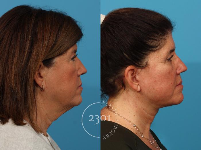 Before & After Face Lift Case 887 Right Side View in Fort Worth, Plano, & Frisco, Texas