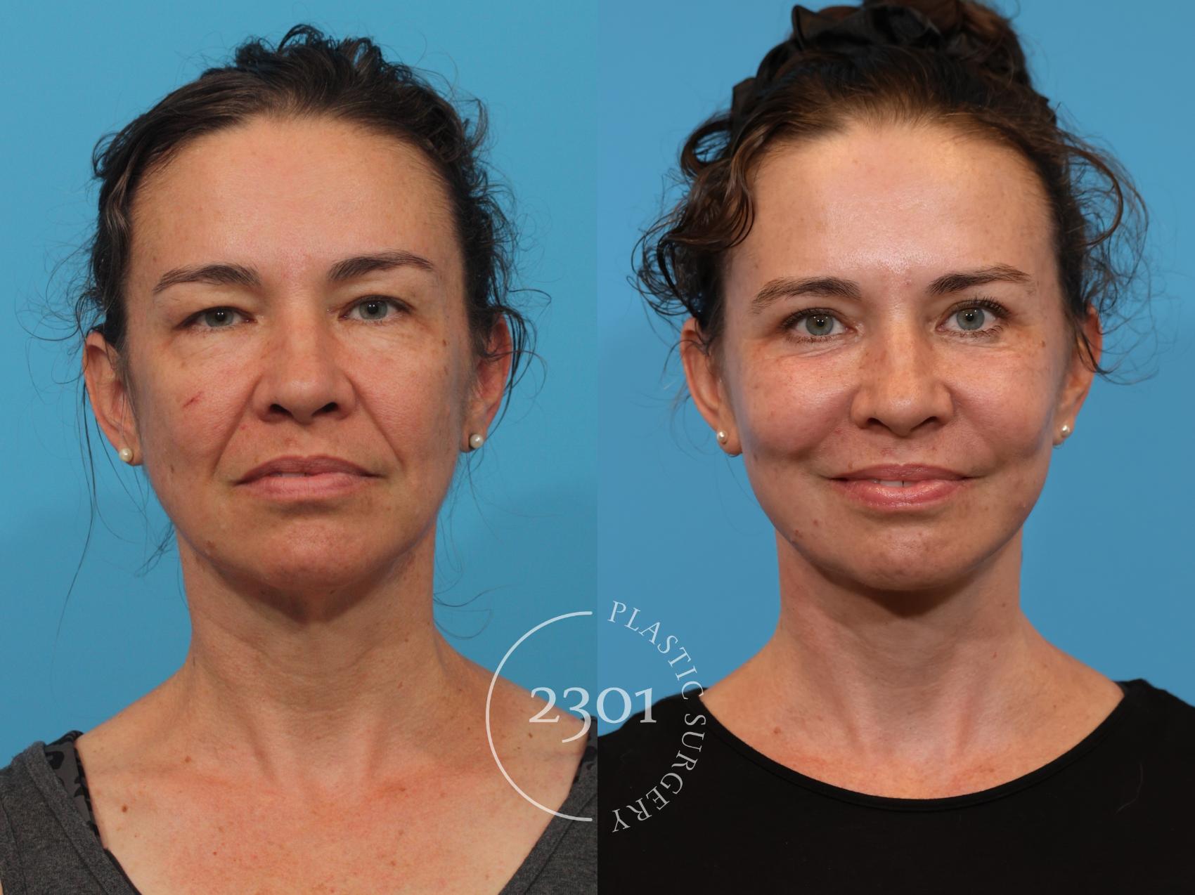 Before & After Blepharoplasty Case 920 Front View in Fort Worth, Plano, & Frisco, Texas