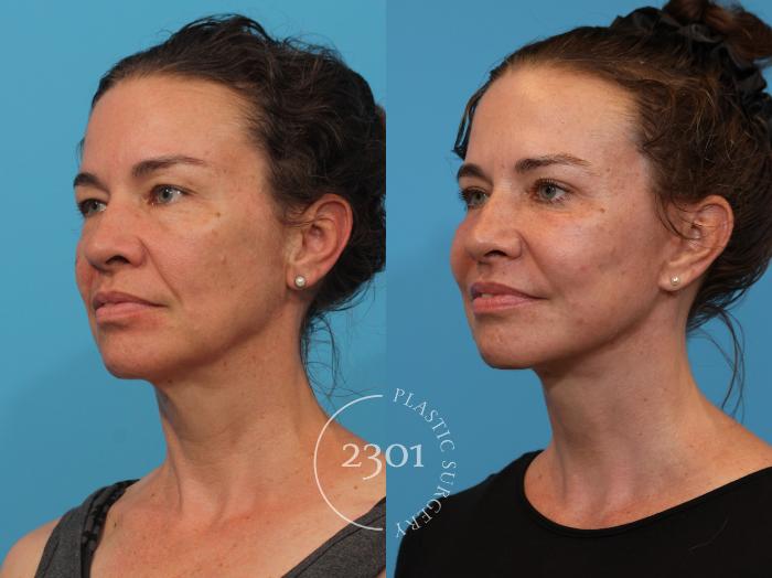 Before & After Blepharoplasty Case 920 Left Oblique View in Fort Worth, Plano, & Frisco, Texas