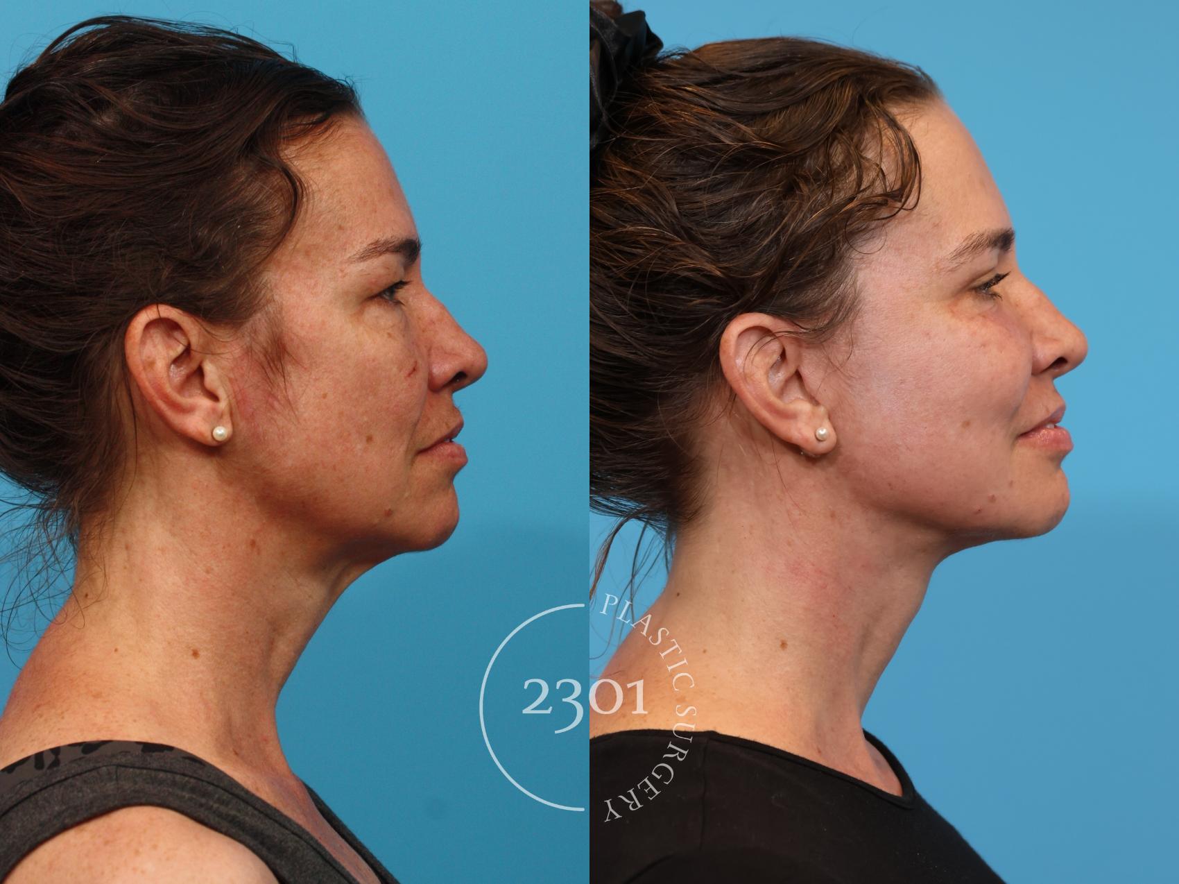 Before & After Blepharoplasty Case 920 Right Side View in Fort Worth, Plano, & Frisco, Texas