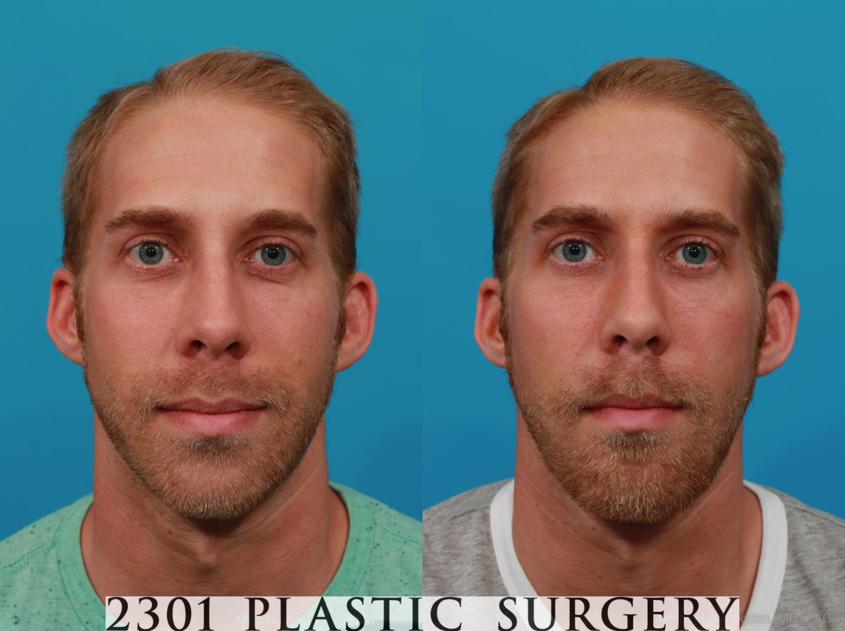 Before & After Facial Implant Case 295 View #1 View in Fort Worth & Frisco, Texas