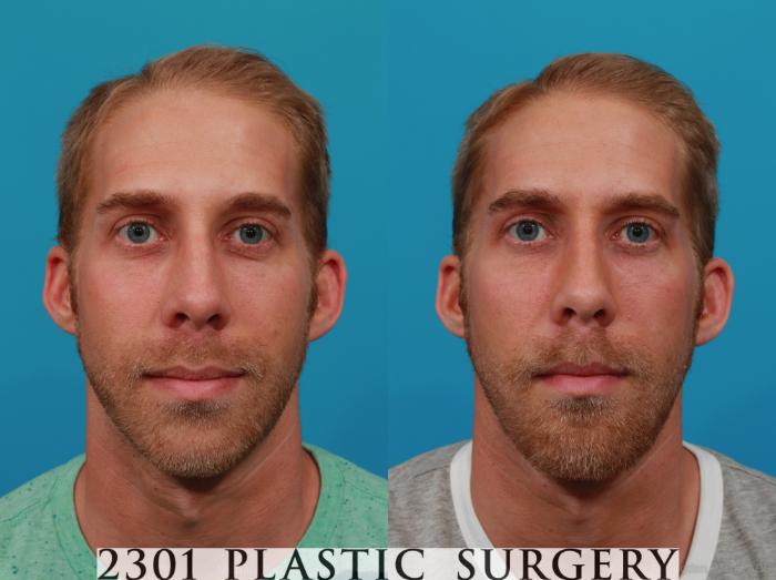 Before & After Facial Implant Case 295 View #1 View in Fort Worth, Plano, & Frisco, Texas