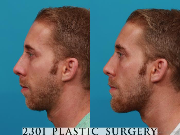 Before & After Facial Implant Case 295 View #2 View in Fort Worth, Plano, & Frisco, Texas