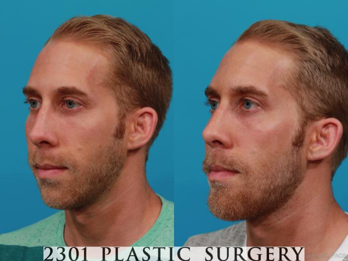Before & After Facial Implant Case 295 View #3 View in Fort Worth, Plano, & Frisco, Texas