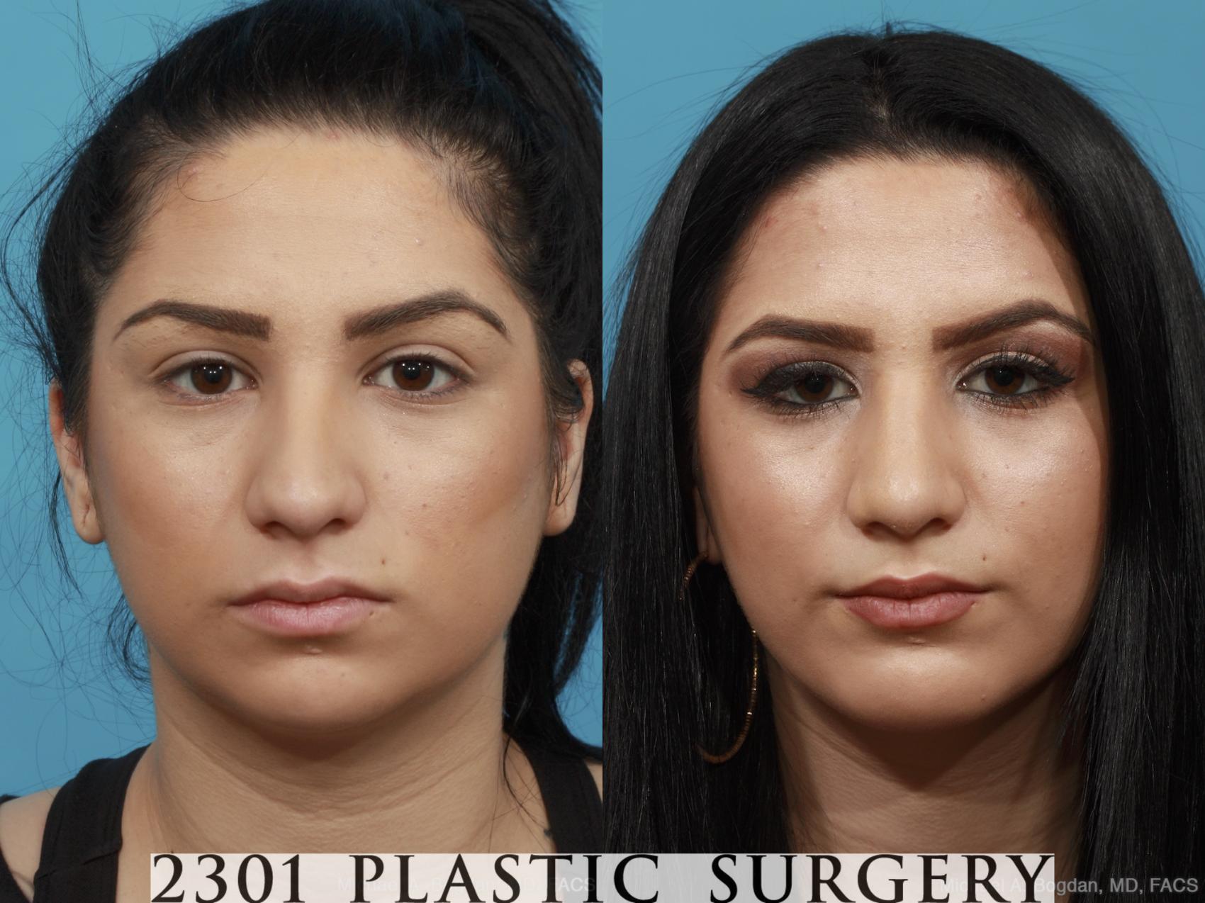 Before & After Facial Implant Case 439 View #1 View in Fort Worth & Frisco, Texas