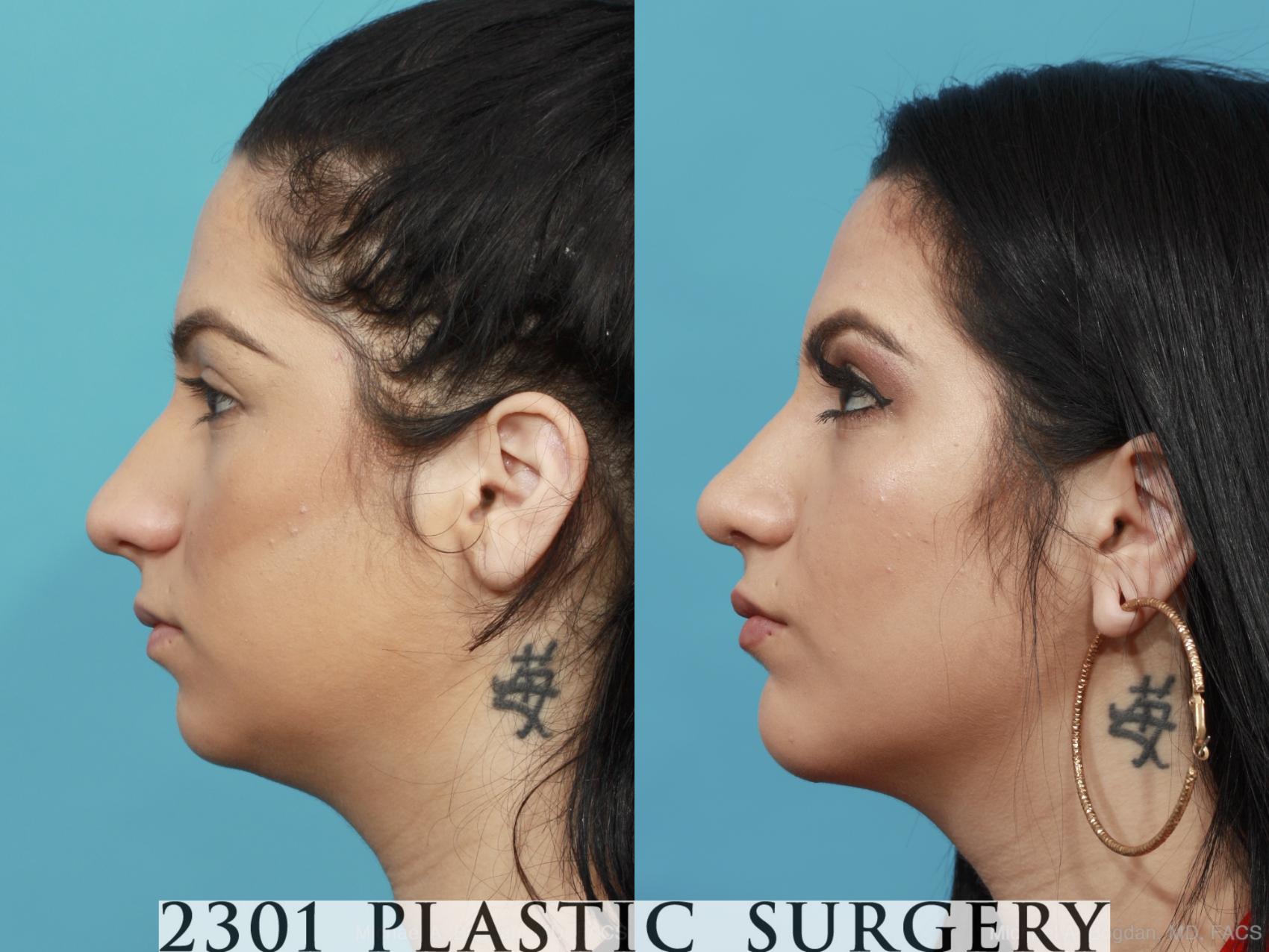 Before & After Facial Implant Case 439 View #2 View in Fort Worth, Plano, & Frisco, Texas
