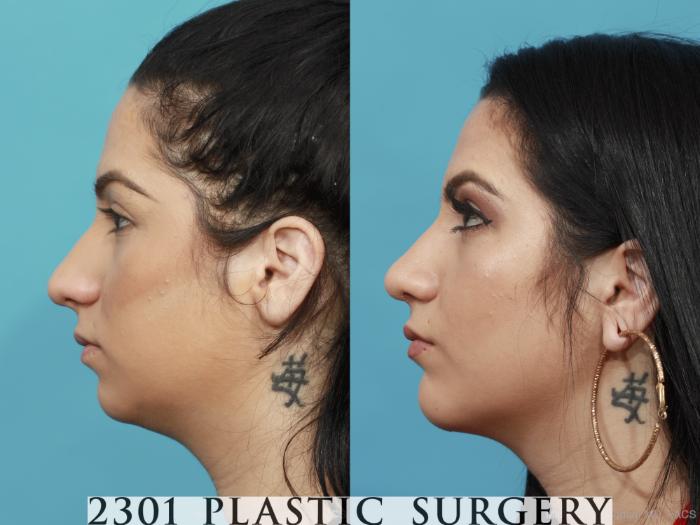 Before & After Rhinoplasty Case 439 View #2 View in Fort Worth, Plano, & Frisco, Texas