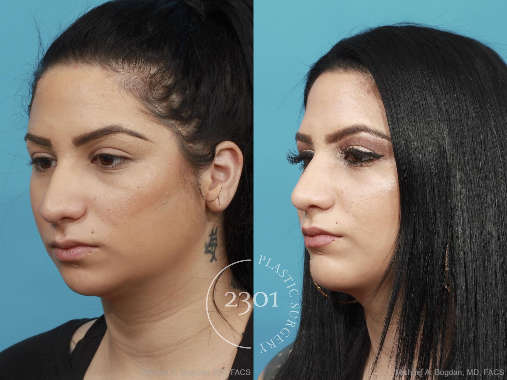 Before & After Rhinoplasty Case 439 View #3 View in Fort Worth, Plano, & Frisco, Texas