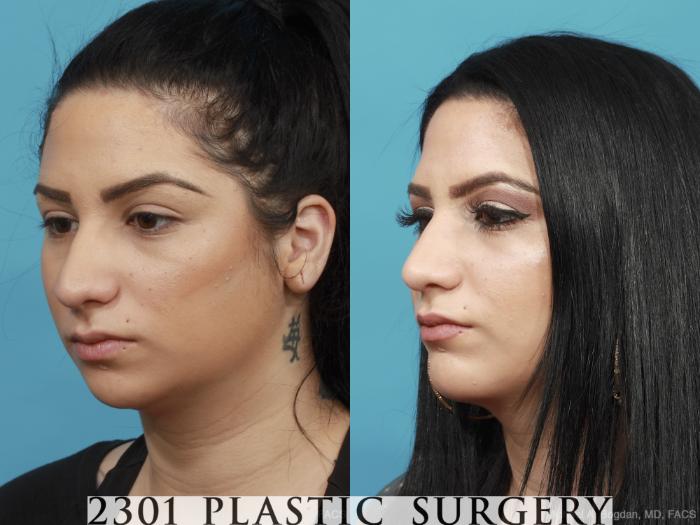 Before & After Facial Implant Case 439 View #3 View in Fort Worth, Plano, & Frisco, Texas