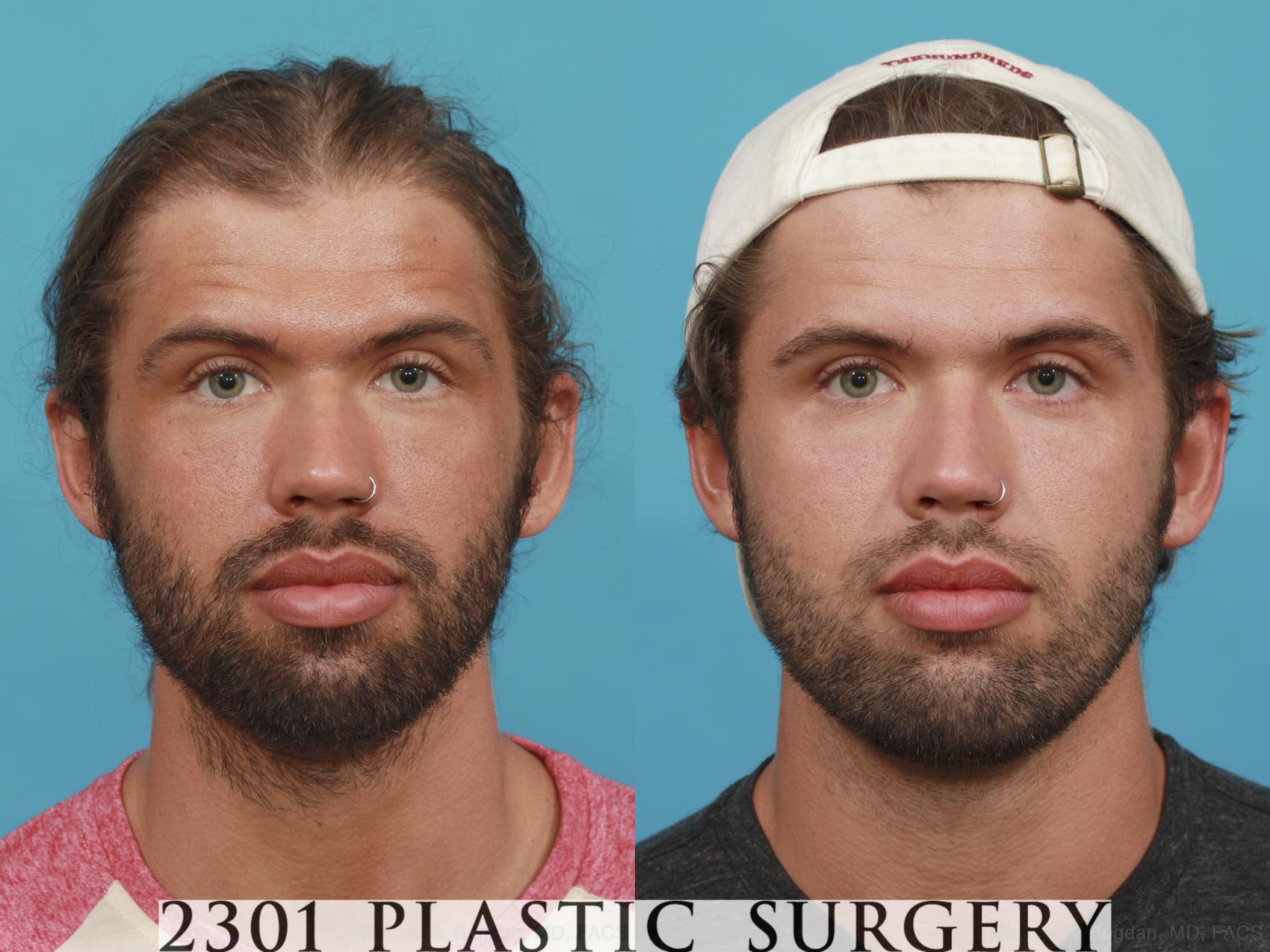Before & After Facial Implant Case 489 View #1 View in Fort Worth & Frisco, Texas