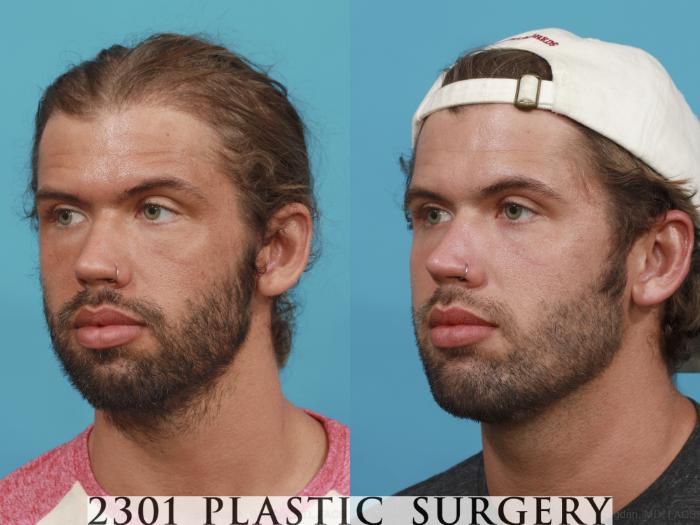 Before & After Facial Implant Case 489 View #2 View in Fort Worth & Frisco, Texas