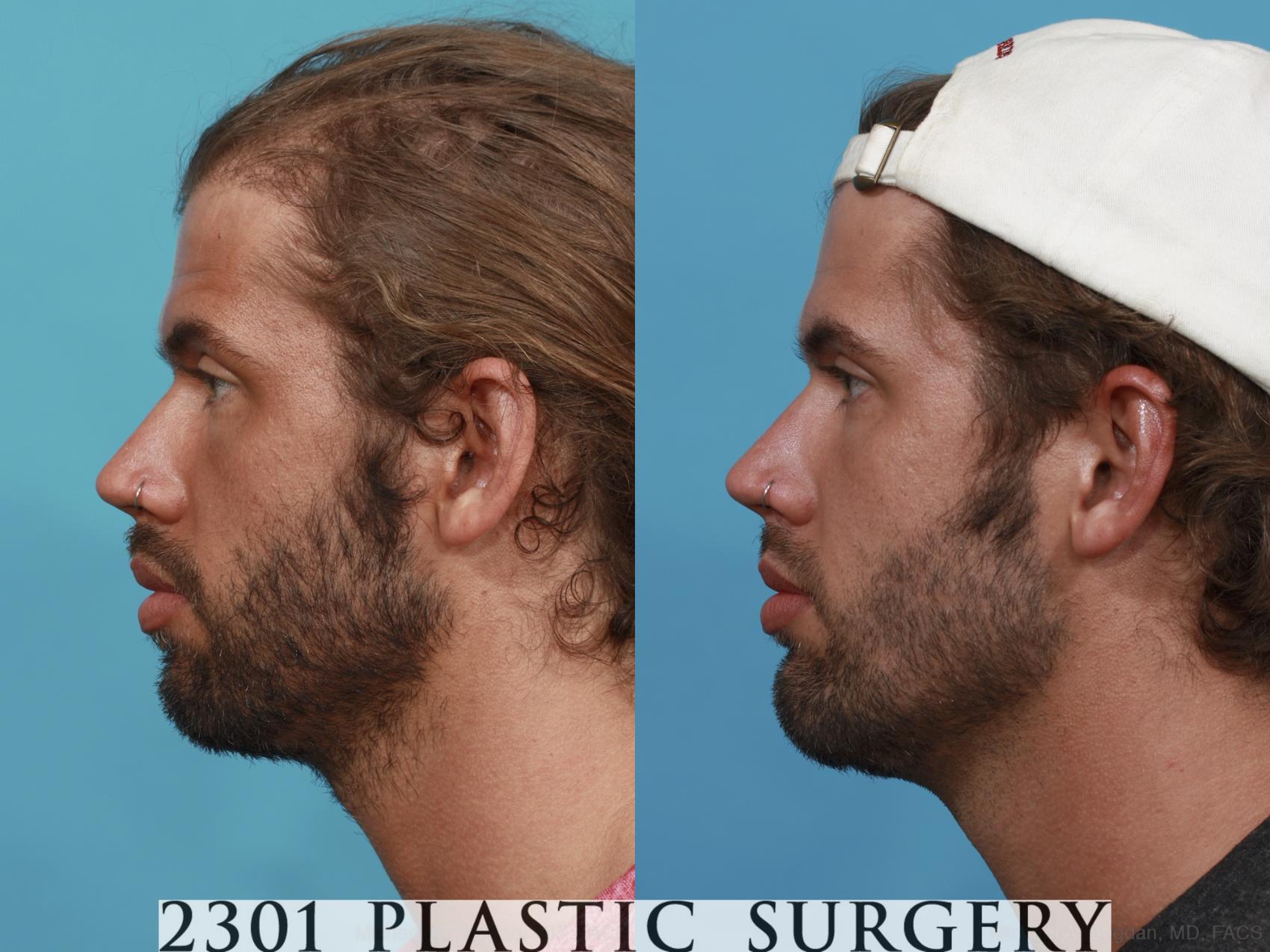 Before & After Facial Implant Case 489 View #3 View in Fort Worth & Frisco, Texas