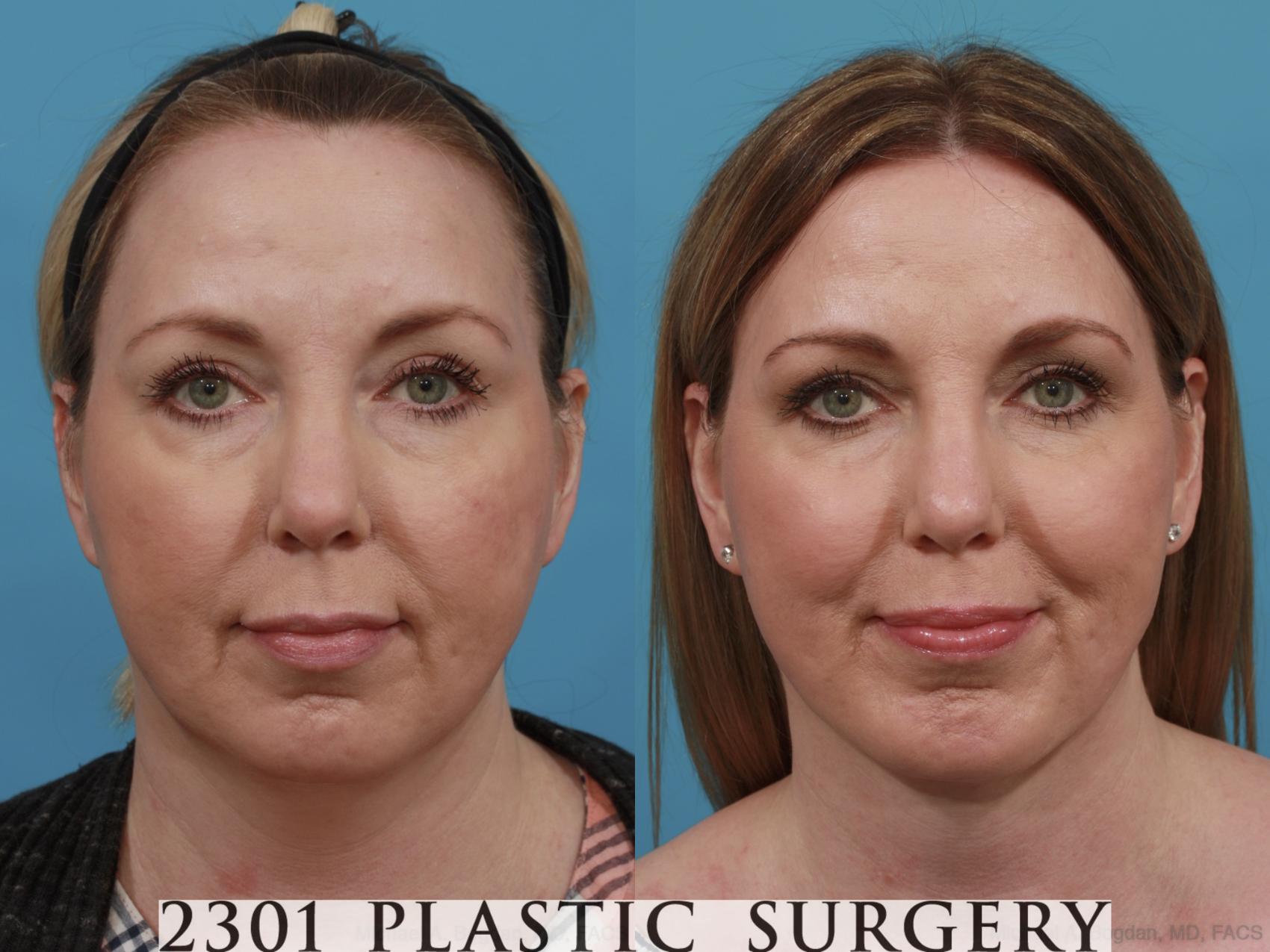 Before & After Neck Liposuction Case 575 View #1 View in Fort Worth & Frisco, Texas