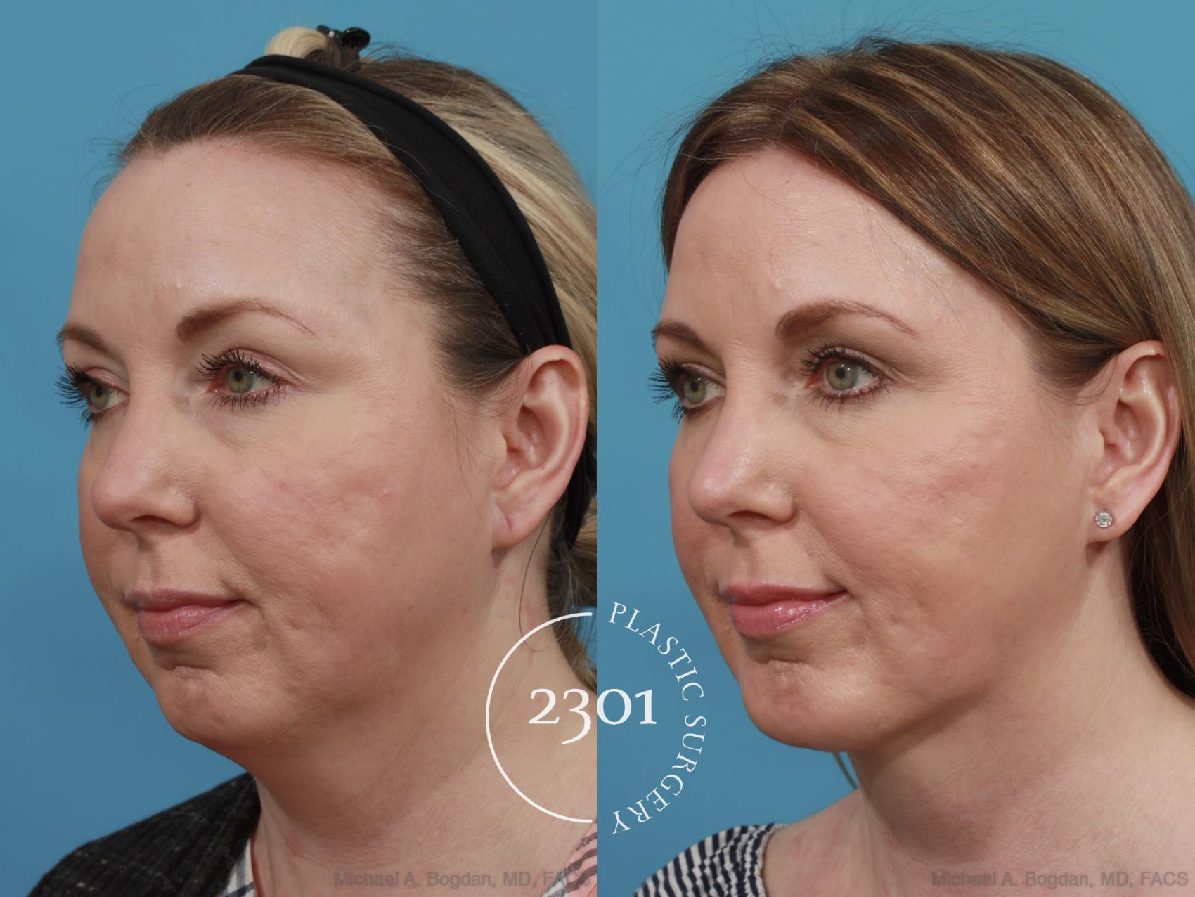 Before & After Neck Liposuction Case 575 View #2 View in Fort Worth, Plano, & Frisco, Texas