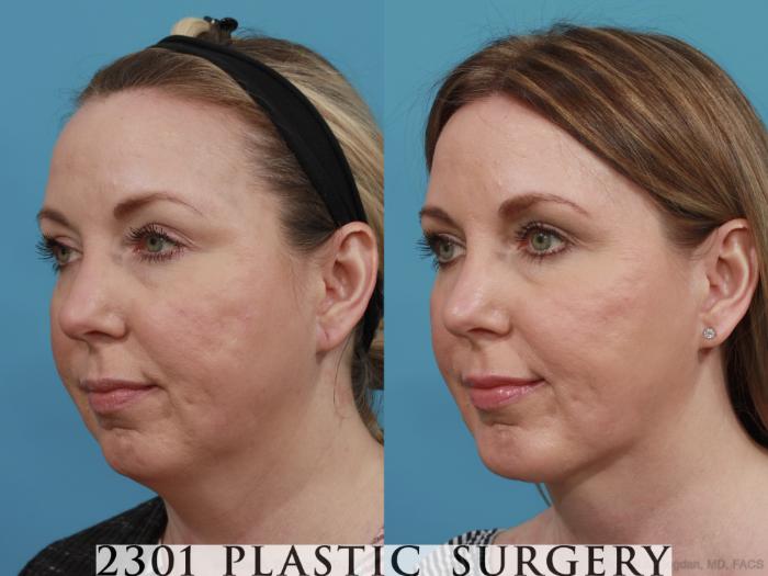 Before & After Neck Liposuction Case 575 View #2 View in Fort Worth, Plano, & Frisco, Texas