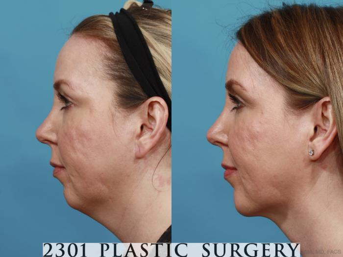 Before & After Facial Implant Case 575 View #3 View in Fort Worth, Plano, & Frisco, Texas