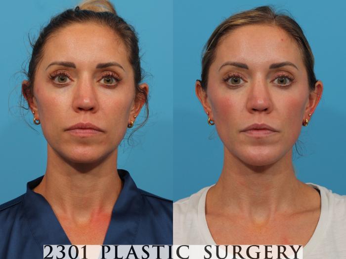 Before & After Facial Implant Case 770 Front View in Fort Worth, Plano, & Frisco, Texas