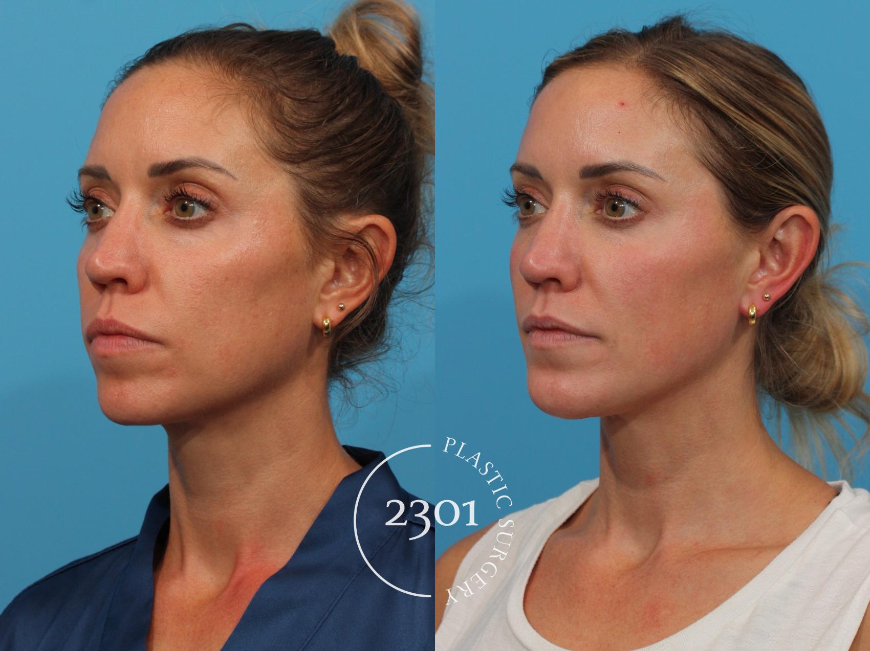Before & After Facial Implant Case 770 Left Oblique View in Fort Worth, Plano, & Frisco, Texas