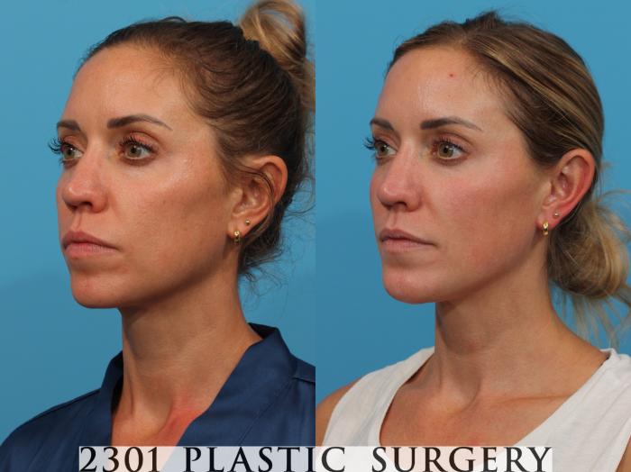 Before & After Facial Implant Case 770 Left Oblique View in Fort Worth, Plano, & Frisco, Texas