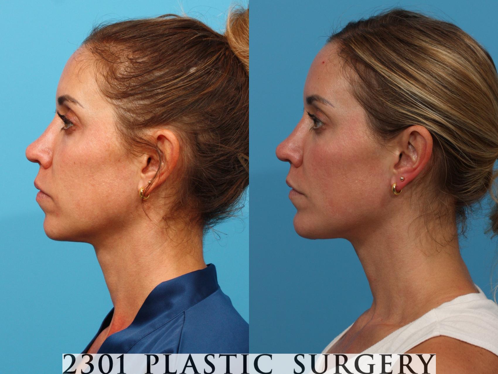 Before & After Facial Implant Case 770 Left Side View in Fort Worth, Plano, & Frisco, Texas