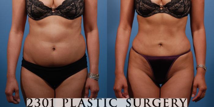 Before & After Liposuction - Abdomen Case 138 View #1 View in Fort Worth & Frisco, Texas