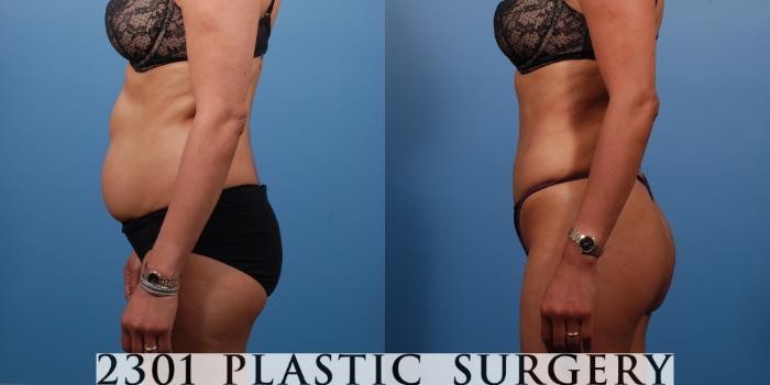 Before & After Liposuction Case 138 View #2 View in Fort Worth & Frisco, Texas