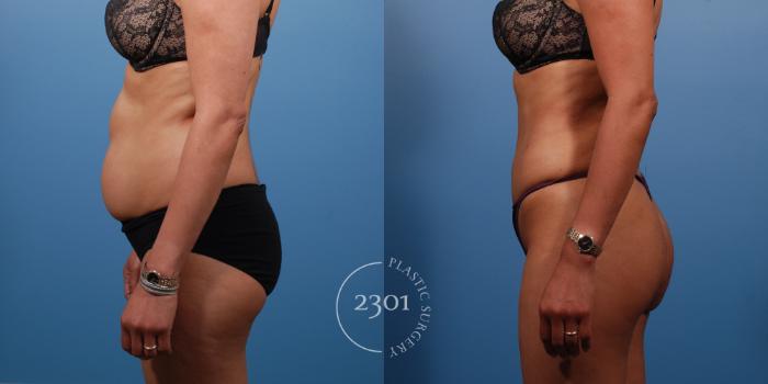 Before & After Liposuction - Abdomen Case 138 View #2 View in Fort Worth, Plano, & Frisco, Texas