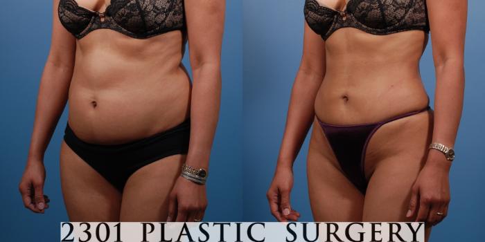 Before & After Liposuction Case 138 View #3 View in Fort Worth & Frisco, Texas