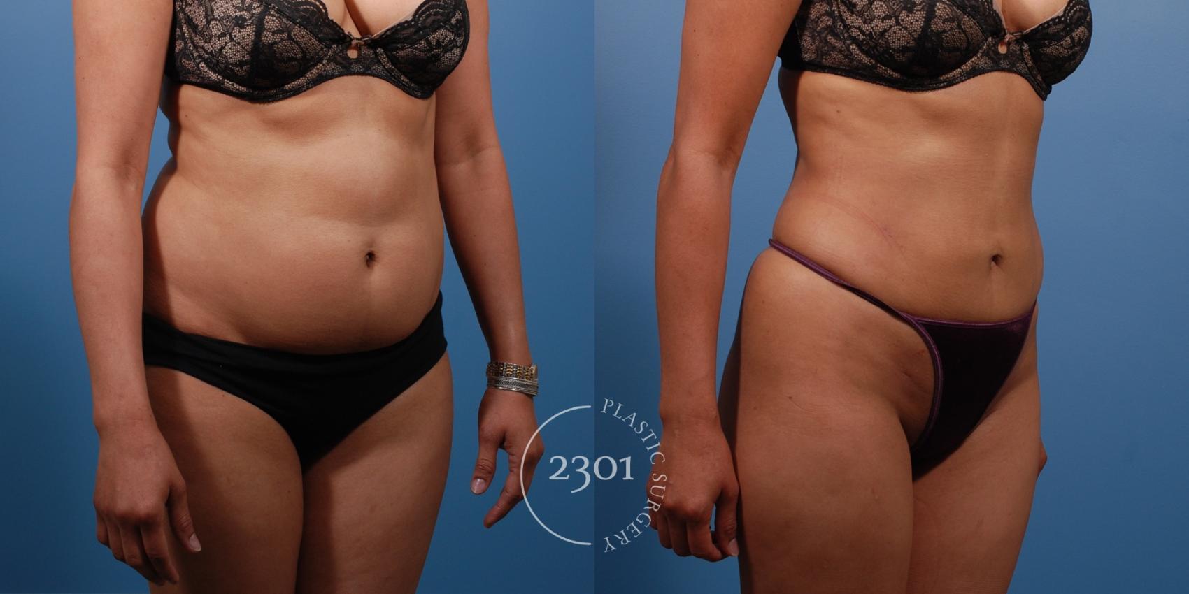 Before & After Liposuction Case 138 View #4 View in Fort Worth, Plano, & Frisco, Texas