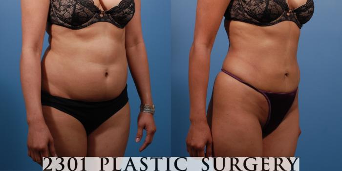 Before & After Liposuction Case 138 View #4 View in Fort Worth & Frisco, Texas