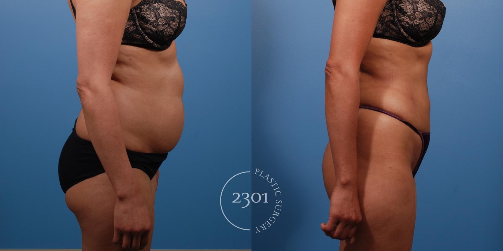 Before & After Liposuction Case 138 View #5 View in Fort Worth, Plano, & Frisco, Texas