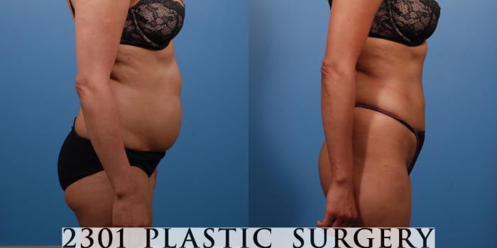 Before & After Liposuction Case 138 View #5 View in Fort Worth & Frisco, Texas