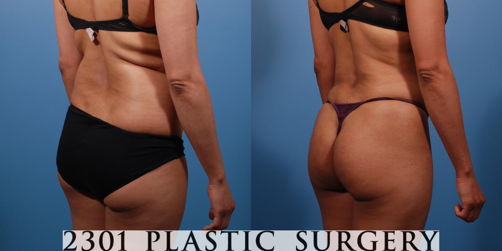 Before & After Liposuction Case 138 View #6 View in Fort Worth & Frisco, Texas