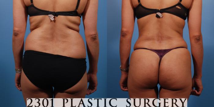 Before & After Liposuction Case 138 View #7 View in Fort Worth & Frisco, Texas