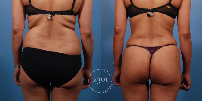 Liposuction of Back and Flanks - Associates in Plastic Surgery