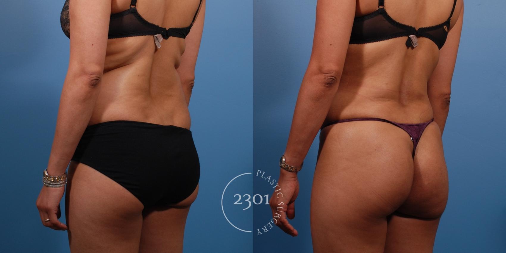 Before & After Liposuction Case 138 View #8 View in Fort Worth, Plano, & Frisco, Texas