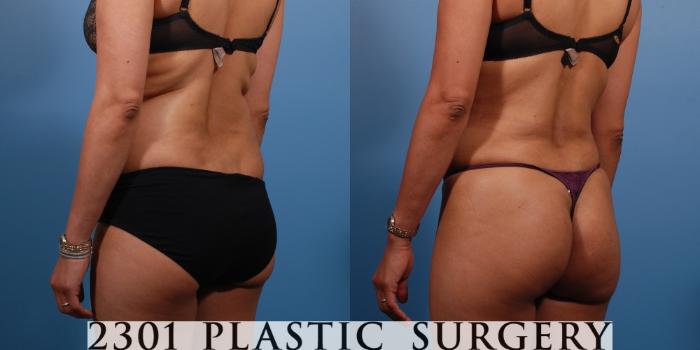 Before & After Liposuction Case 138 View #8 View in Fort Worth & Frisco, Texas