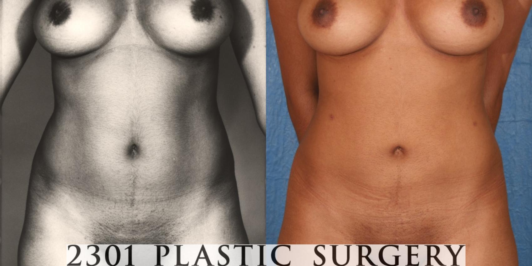 Before & After Liposuction Case 35 View #1 View in Fort Worth, Plano, & Frisco, Texas