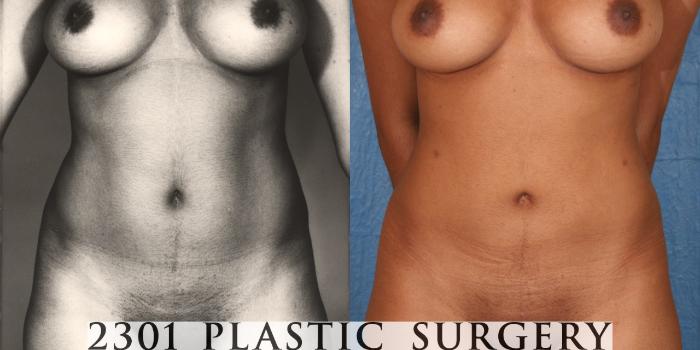 Before & After Liposuction - Abdomen Case 35 View #1 View in Fort Worth & Frisco, Texas