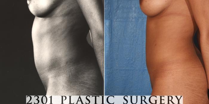 Before & After Liposuction Case 35 View #2 View in Fort Worth, Plano, & Frisco, Texas