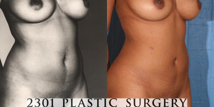 Before & After Liposuction Case 35 View #3 View in Fort Worth, Plano, & Frisco, Texas
