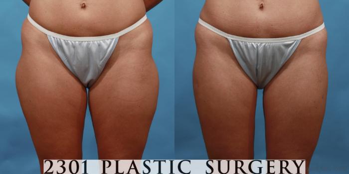 Before & After Liposuction Case 486 View #1 View in Fort Worth, Plano, & Frisco, Texas