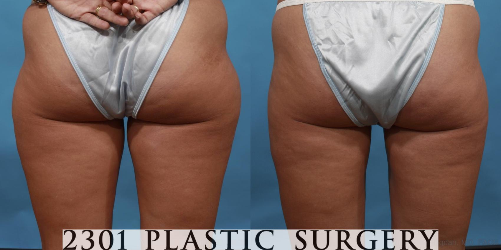 Before & After Liposuction Case 486 View #2 View in Fort Worth & Frisco, Texas