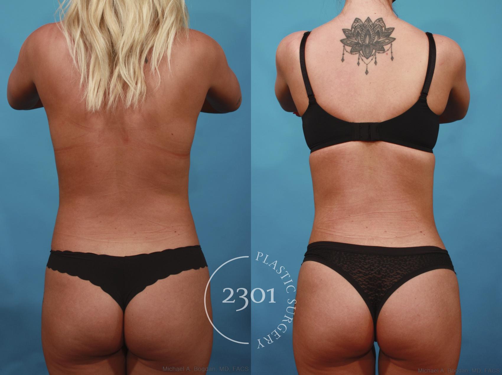 Before & After Liposuction Case 669 Back View in Fort Worth, Plano, & Frisco, Texas