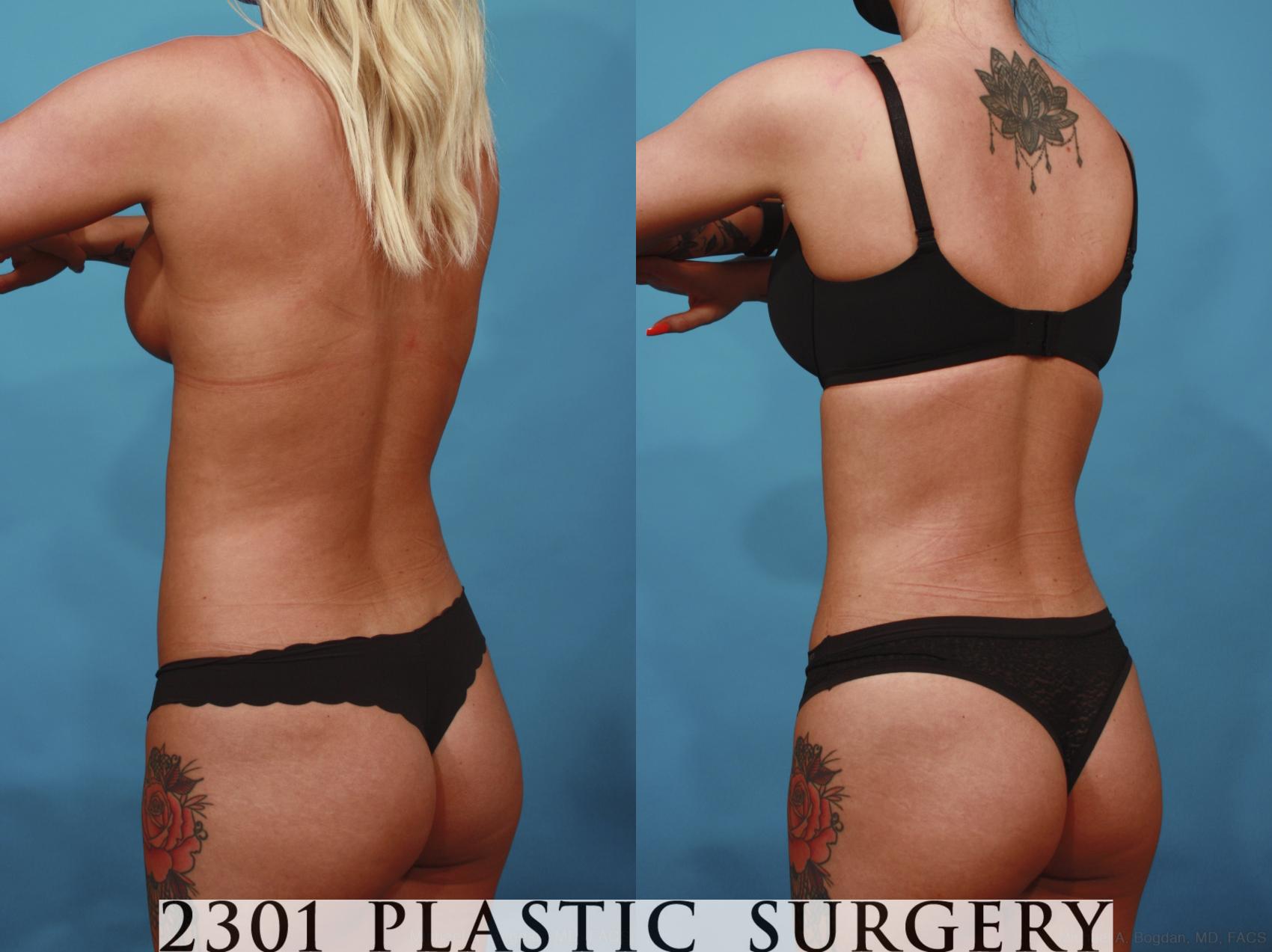 Before & After Liposuction Case 669 Back Left Oblique View in Fort Worth, Plano, & Frisco, Texas